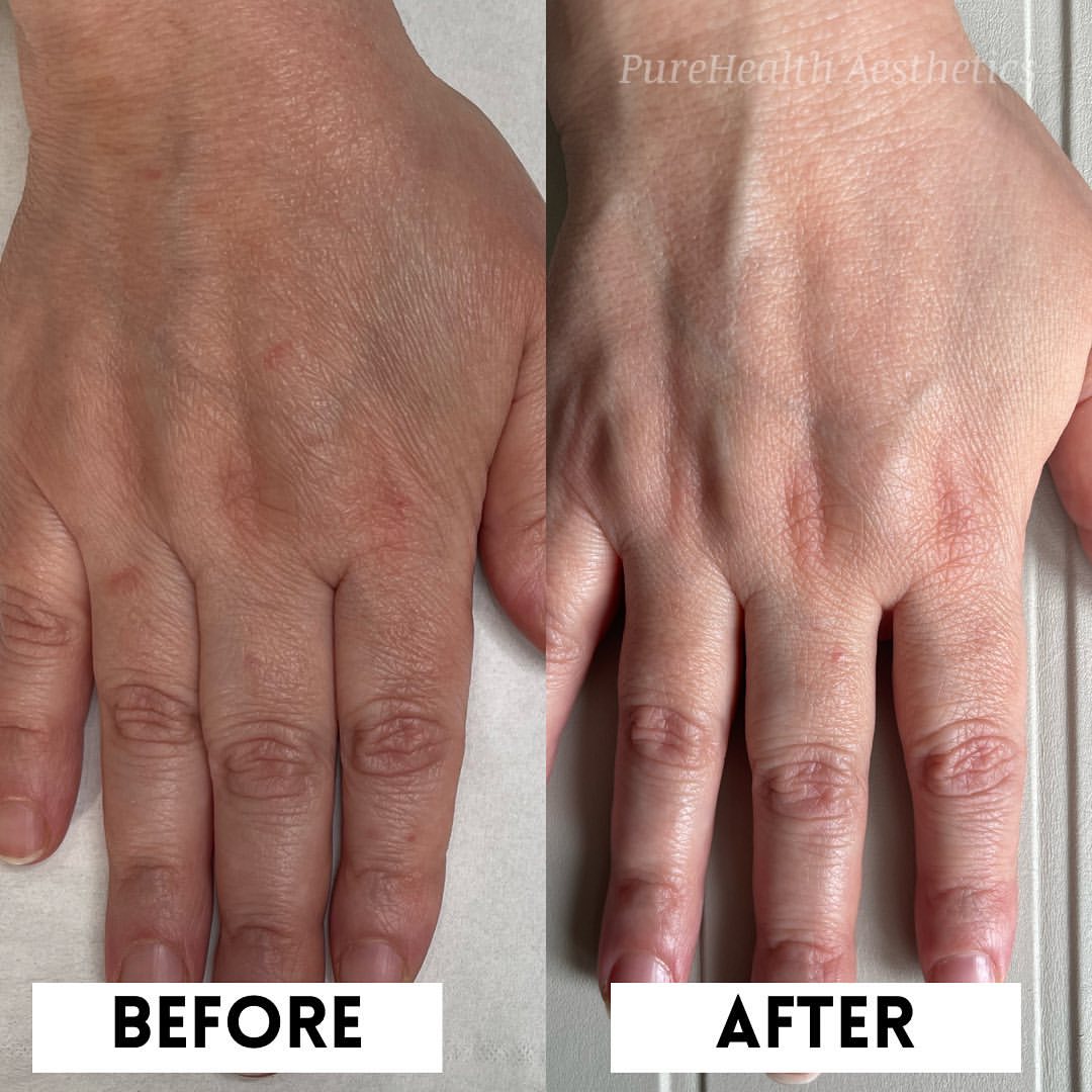 hand rejuvenation before and after
