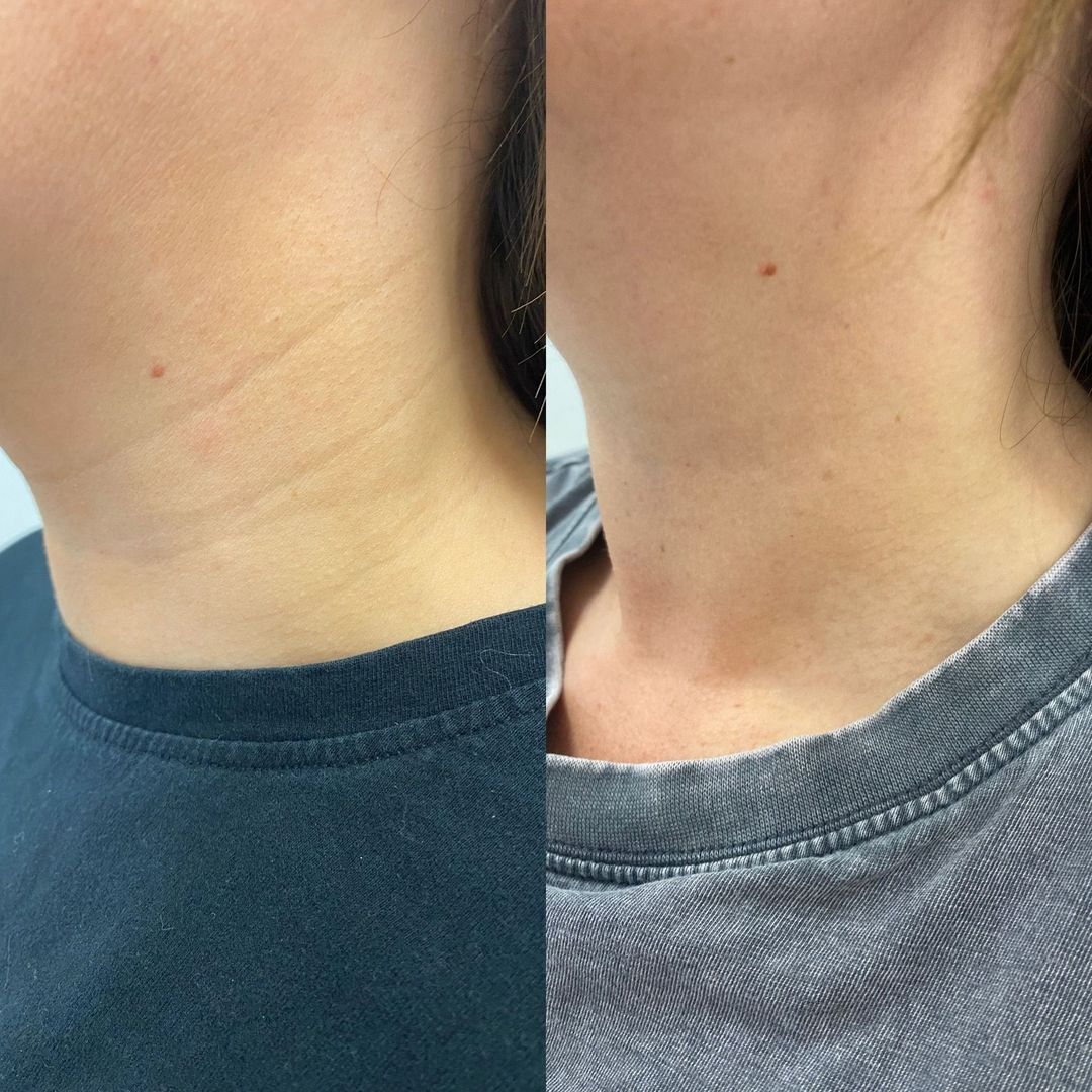 Seventy Hyal neck